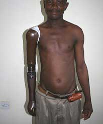 Fitting of a trans-humeral prosthesis
