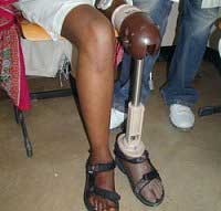ICRC polypropylene knee joint